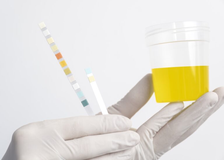 Gloved hands holding a urine sample container and test strips for medical analysis.